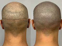 تقاوت برداشت مو در روش های FUE و FUT