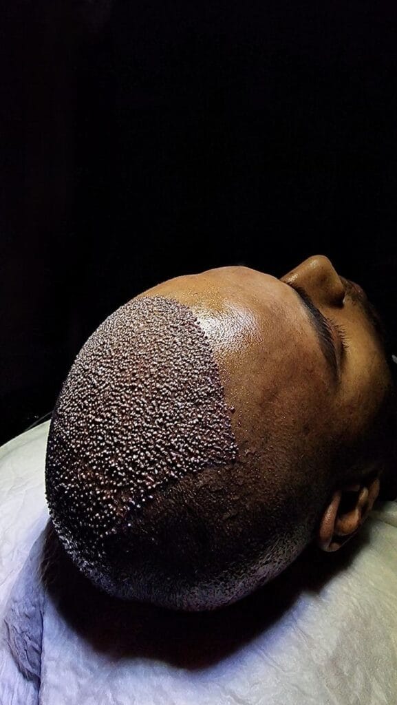 کاشت مو به روش FUE