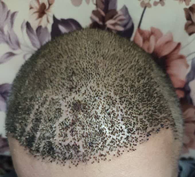 ترک خوردگی های بعد از کاشت مو