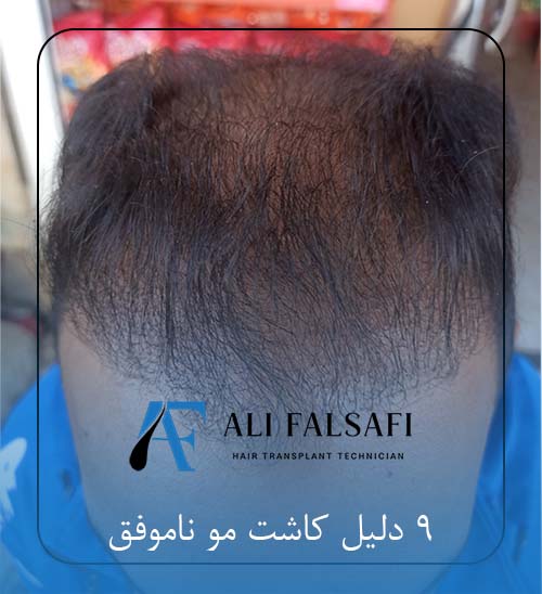 9 دلیل کاشت مو ناموفق