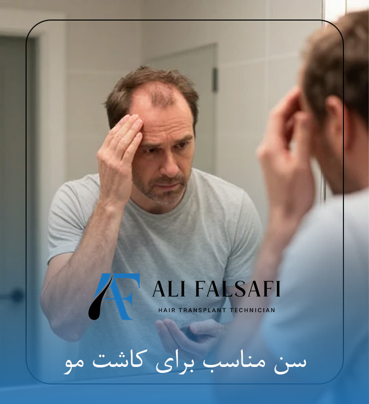 سن مناسب برای کاشت مو
