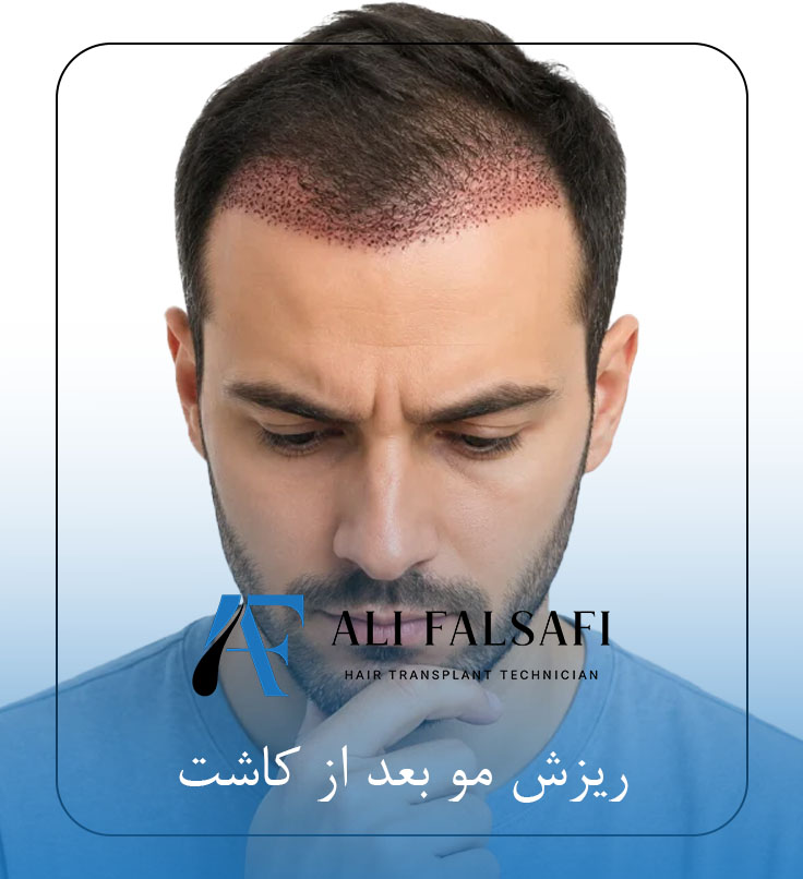 ریزش مو بعد از کاشت